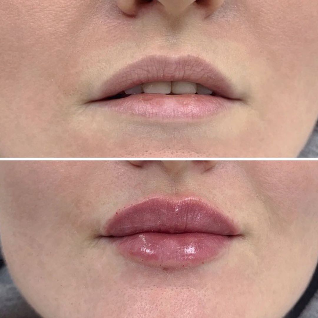 Увеличение губ препаратом Ювидерм: фото до и после