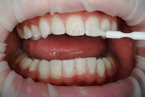 Этапы комплексной чистки зубов
