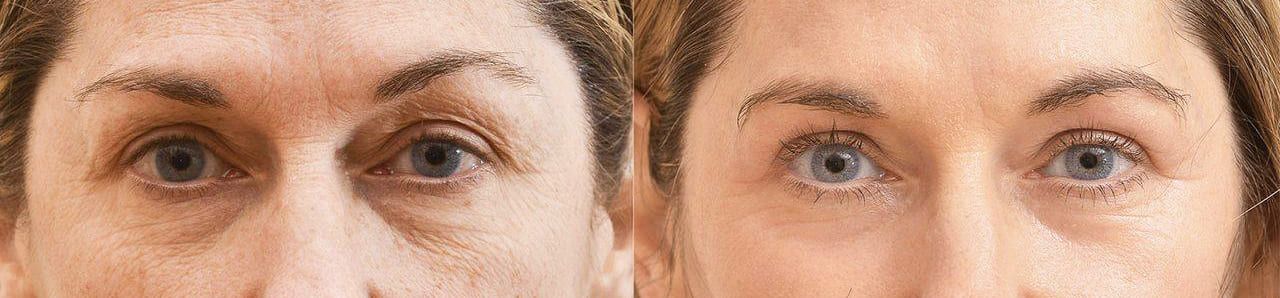 До и после биоревитализации кожи вокруг глаз в Москве