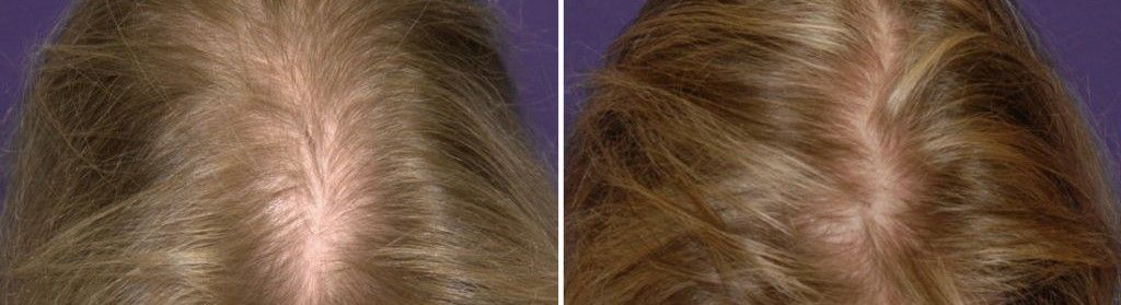 Пример фото до и после лечения алопеции в Москве с помощью плазмолифтинга