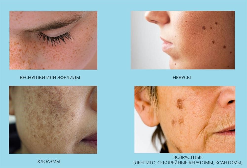 Виды гиперпигментации на коже лица